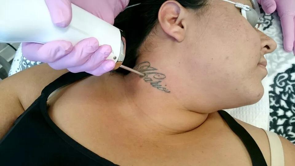Top Ten Reasons Why Coloradans Remove Tattoos — and How to Do It