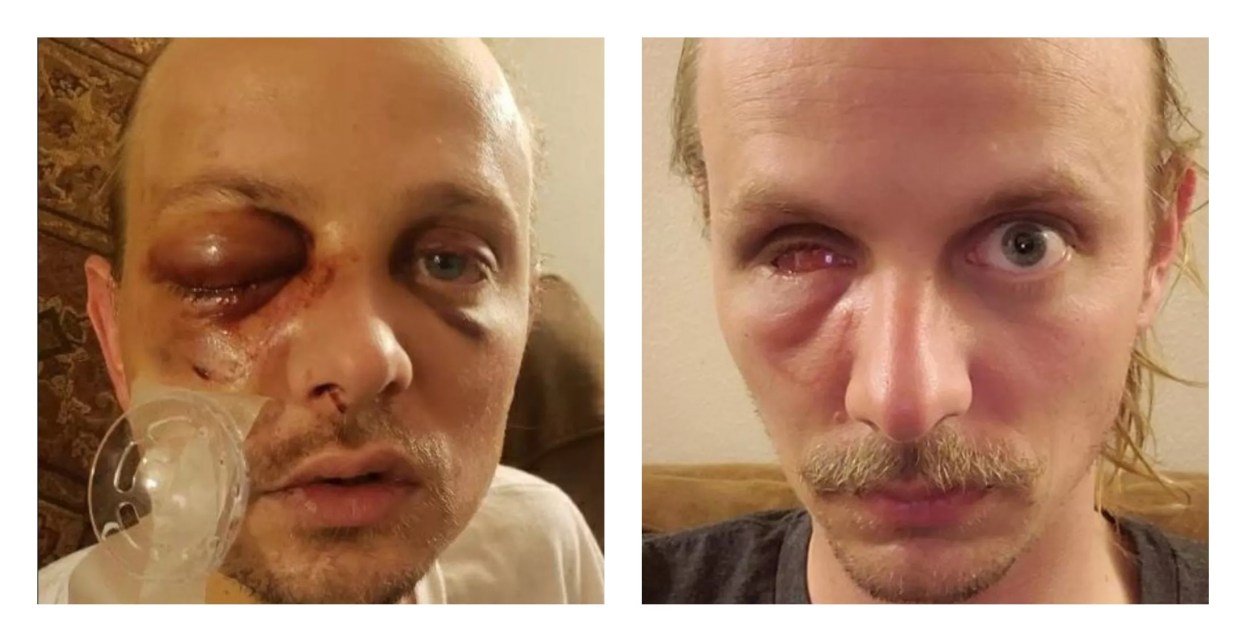 Why Russell Strong Is Suing Denver for Losing Eye at George Floyd Rally