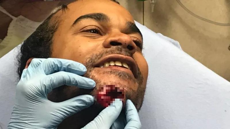 Denver Pushes Back Against Protester Suing Over His Chin Being Blown Off