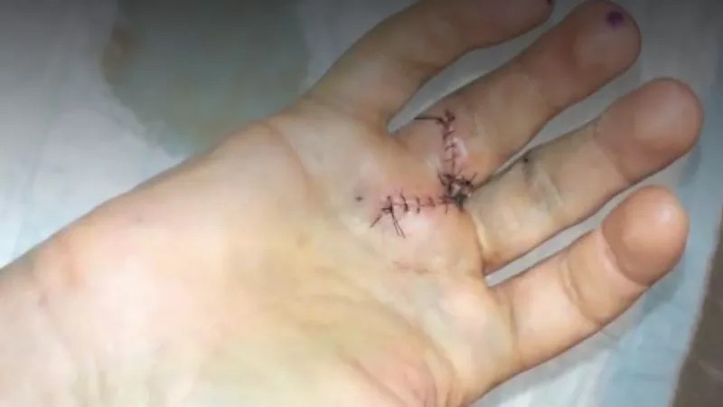 Trevor Hughes’s Finger Costs Denver-Area Cops $485K